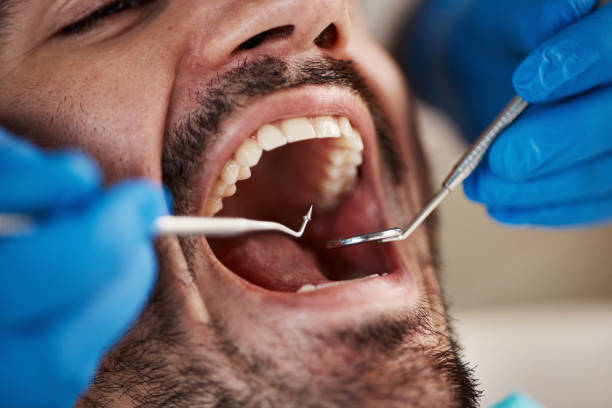 Best Emergency Wisdom Teeth Removal in Friendship Heights Village, MD